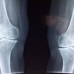 What Happens to Artificial Joints During Cremation